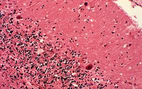 Kuru is a very rare, incurable and invariably fatal neurodegenerative disorder that was formerly common among the fore people of papua new guinea. ÙƒÙˆØ±Ùˆ Ù…Ø±Ø¶ Ø§Ù„Ø¶Ø­Ùƒ Ø§Ù„Ù…Ù…ÙŠØª Ø§Ù„Ø°ÙŠ Ù‚ØªÙ„ Ø¢Ù„Ø§Ù Ø§Ù„Ø¨Ø´Ù€Ø± Ø§Ø®ØªÙŠØ§Ø±Ø§Øª Ø§Ù„Ù…Ø­Ø±Ø±ÙŠÙ† Ø§Ù„Ø¥Ù…Ø§Ø±Ø§Øª Ø§Ù„ÙŠÙˆÙ…