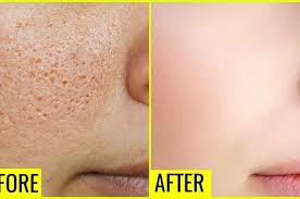 Perbedaannya hanya terdapat pada seberapa lama perawatan tersebut. Alami Dan Permanen Begini Cara Menutup Pori Pori Terbuka Di Wajah Semua Halaman Sajian Sedap