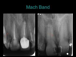 Radiographic Projection Of Objects Step Wedge Darkening Curve Of Films Exposition Darkening Linear Part Ppt Download