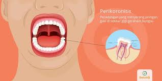 Pijat sakit gigi geraham sangat mudah dilakukan. Perikoronitis Tanda Dan Gejala Penyebab Cara Mengobati Cara Mencegah