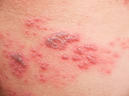 However, people who have herpes simplex virus. Shingles Pain Management Novus Spine Pain Center