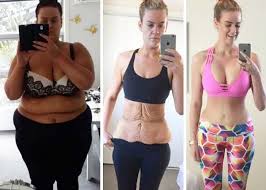 Top 10 Tips Before And After Gastric Bypass Surgery Gastric Bypass Surgery Bariatric Surgery Bariatric