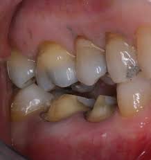 Image result for Occlusal