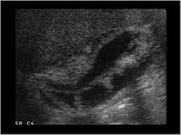 Wk 3 Gallbladder Pathology Abdomen And Retroperitoneum 1 2 Gallbladder And Bile Ducts Case 1 2 4 Gallbladder Mem Gallbladder Medical Ultrasound Ultrasound