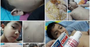 Jadi, di sini elly kongsikan sedikit tips dan petua yang elly amalkan sepanjang 7 hari tersebut. Chicken Pox Besar