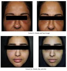 Our hyaluron pen is an innovation that deposits hyaluronic acid filler into the epidermal and upper dermal layers of the skin without traditional. Delayed Hypersensitivity Reaction To Hyaluronic Acid Dermal Filler Fol Ccid