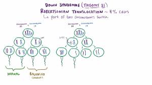 Overview of Down Syndrome