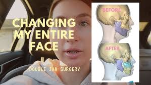 jaw surgery & other life updates