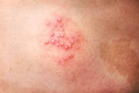 Culebrilla Herpes Banco De Fotos E Imagenes De Stock Istock