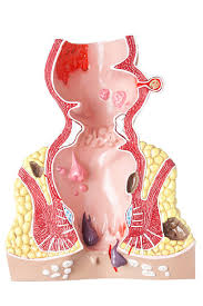 Image result for Ischiorectal Abscess