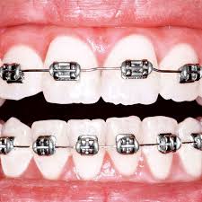 Getting braces put on is one of the easiest parts of having braces! Why Is America Obsessed With Perfect Teeth