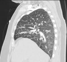 Image result for CHF Observation Unit