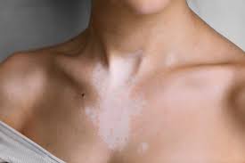 Image result for Postinflammatory Hypopigmentation