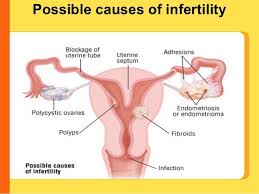 Image result for Female Infertility