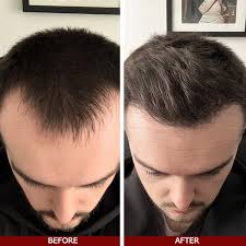 Roll-on para el crecimiento del cabello Be Bodywise | Sérum de romero | Sérum para el crecimiento del cabello – RevivRoot