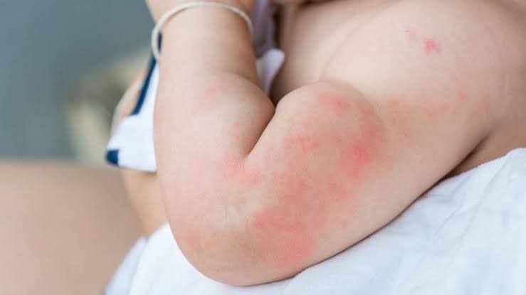 Heboh Anak di Sidoarjo Terpapar HIV Capai 500 Jiwa