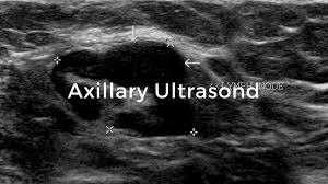 Generally speaking, the denser the tissue, the whiter it appears. Axillary Ultrasound Breast Cancer School For Patients
