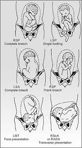 Abnormally positioned (eg, breech presentation). Jaypeedigital Ebook Reader