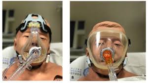 Non-invasive ventilation in the ED: Whom, When, How?