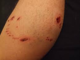 Dog Bite Marks 