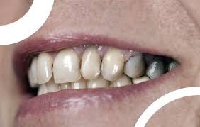 Une carie, ça fait mal et il faut la soigner. La Carie Sur Une Dent L Infection Dentaire Dr Ari Elhyani Chirurgien Dentiste