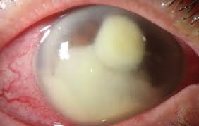 Image result for Keratitis