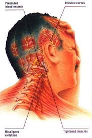 Pin By Irenke Csokasne On A In 2020 Natural Remedies For Migraines Migraines Remedies Headache Treatment