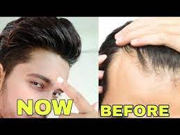 Using shampoo to treat receding hairline teenager is a new way in the last few years. How To Stop Hair Loss And Receding Hairline Hindi How To Solve Receding Hairline Problem Youtube