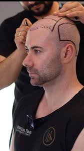 It’s normal for a lot of us to thin and lose our hair. It’s up to you  though if you want to accept that or do something about it. @now.hairtime  without a doubt isn’t just a hair transplant company, ...