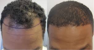 This type of hair has better coverage and greater bulk than fine hair, so fewer follicles may need to be transplanted to get the desired result. Men S African American Hair Transplant Dr Sean Behnam