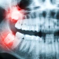 I have an infection and have to get two of my wisdom teeth removed. Tooth Extractions Health Plus Dental Se Calgary Dentist In Midnapore