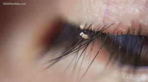 Diy baby shampoo and baking soda lash cleanser. Doctors Warn About Lice Infestations In Eyelash Extensions Wzzm13 Com
