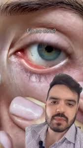 Vem entender o que é esse "fiozinho" nos olhos! Aproveita para compartilhar  com um amigo! 🤝👀, #oftalmo #oftalmológica #oftalmologista #visao #olhos