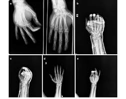 Image result for Hand Fracture