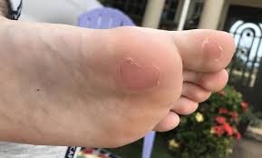 This is a common skin condition that can occur on your skin especially on hand, finger, foot, heel and ankle. 13 Tips To Avoid Blisters From Soccer Cleats Master Soccer Mind
