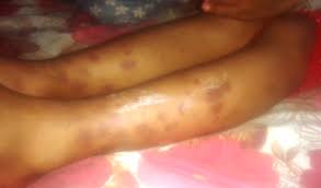 People with henoch's purpura are not affected by joint disease. Henoch Schonlein Purpura Successfully Treated With Dexamethasone A Case Report Of Six Year Old Female Journal Of Medical Research And Innovation