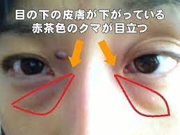 目の下のたるみやクマの取り方って 3ヶ月で解消した方法とは bitomos 目の下 目の下のたるみ 顔のエクササイズ