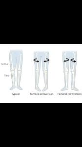 Image result for Femoral Retroversion
