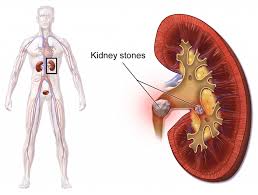 20 Home Remedies For Kidney Stones That Work Fast Home Remedies For Kidney Stones Are Of Great Interest From Individuals Suffering Fro Signs Of Kidney Stones Kidney Detox Cleanse Kidney Cleanse