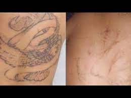 View before of after photos of san diego patients. Dermabrasion Still Effective Still Valid For Tattoo Removal Youtube