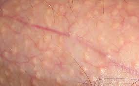 Leave the treatment overnight and shower off in the morning. Fordyce Spots Symptoms Causes Treatments Remedies