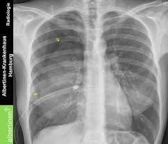A pneumothorax can be caused by: Pneumothorax P A Doccheck