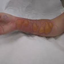 We did not find results for: Eastern Iowa Child Scarred By Salt And Ice Internet Challenge Kgan