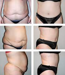 We did not find results for: Minimally Invasive Tummy Tuck Surgery Metro Detroit Mi