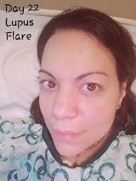 How to manage blood sugar while taking prednisone?