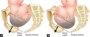 Image result for Manual Rotation in Occipitoposterior Presentation