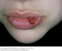 Image result for Pyogenic Granuloma