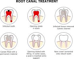 We did not find results for: Root Canal Treatment Pure Dental Practice