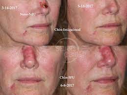 It can be applied at home and is typically used twice a day for two to four weeks. 5 Fluorouracil Archives Skin Cancer And Reconstructive Surgery Center