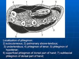 Image result for phlegmon of hand)
